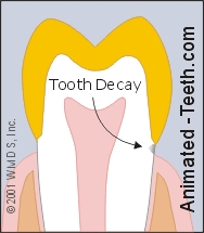 Animation showing how a cavity can extend underneath a dental crown.