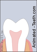 Animation showing the preparation (shaping) a tooth for a dental crown.