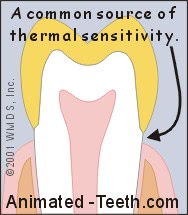 Graphic stating that thermal sensitivity may come from tooth surfaces at the crown's edge.