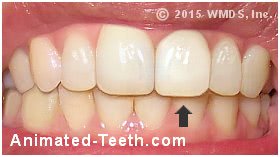 A picture of a dental crown that no longer matches the color of its neighboring teeth.