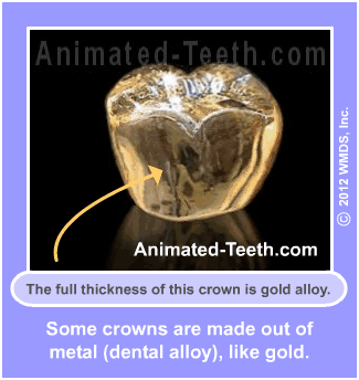 Slideshow outlining different types of dental crown construction.
