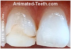 Picture of tooth with stained and deteriorated dental bonding.