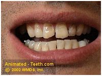 Picture of front teeth worn down by teeth grinding.