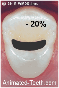 Dental crown vs big filling. Factors to consider when choosing.