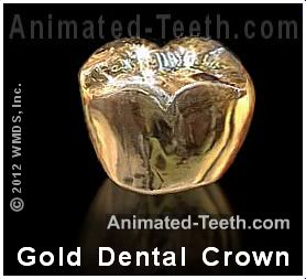 Picture of a deep-yellow gold dental crown.