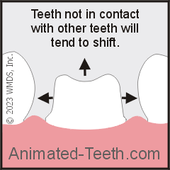 Graphic showing that teeth not in contact will shift.