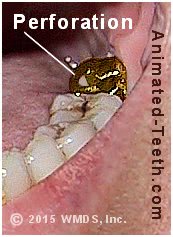 Picture of a perforated gold dental crown.