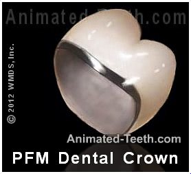 Picture of a porcelain-fused-to-metal dental crown.