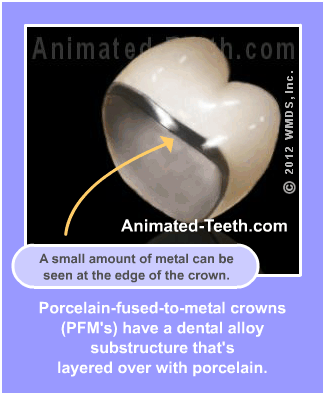 Slideshow explaining porcelain-fused-to-metal dental crowns.