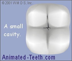 Dental crown vs big filling. Factors to consider when choosing.