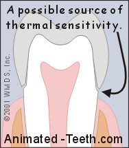 Graphic showing that the imprecise fit of a temporary crown may explain its thermal sensitivity.