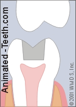 Animation showing tooth cusp fracture.