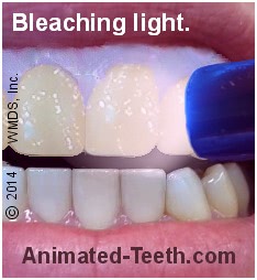 Picture of light activation of tooth whitening gel.