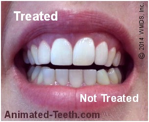 Picture showing a comparison of the whitened and untreated teeth.