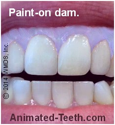 Picture of paint-on dental dam in place for bleaching treatments.
