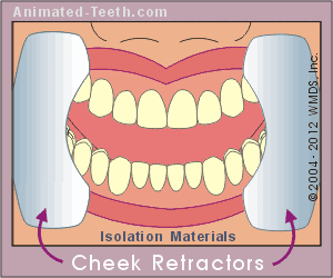 Animation showing ways teeth are isolated during tooth bleaching treatments.