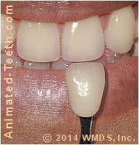Picture of using a shade guide to take a tooth's shade.