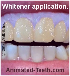 Picture of whitening gel applied that does not require light activation.