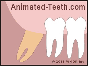 Animation showing that a eugenol dressing is placed in the opening of the tooth's dry socket.