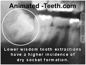 Graphic stating that lower wisdom tooth extractions have an elevated incidence of dry socket formation.