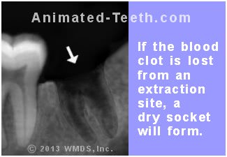 Graphic stating that if an extraction site's blood clot is lost, a dry socket will form.'s blood clot is lost, a dry socket will form.