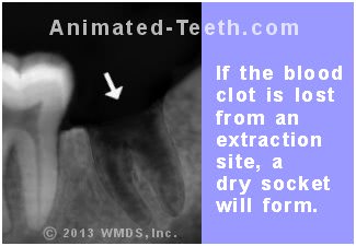 blood clot wisdom teeth bad