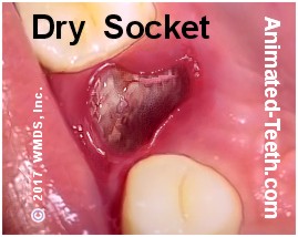 Dry socket teeth