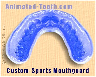 Picture of a Custom mouthguard.