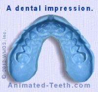 Picture of a dental impression used to make a custom mouthguard.