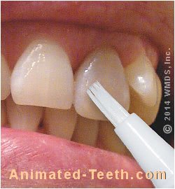 Link to Whitening Pen Advantages section.