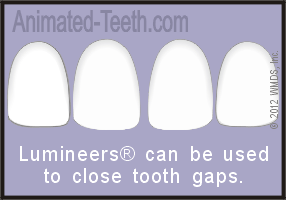 Diagram showing how tooth gaps can be closed by placing veneers.
