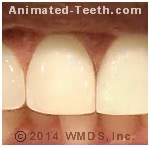 Picture of a tooth restored with a porcelain laminate.