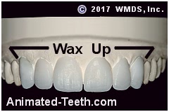 A diagnostic wax-up of a Lumineers® case.