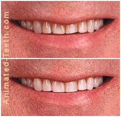 Ultra-thin veneers used to make a color change for teeth. Before & After.