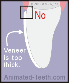 Animation showing how placing no-drill Lumineers® can create a tooth that's too over contoured.