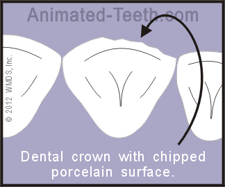 Diagram illustrating how Lumineers® can be used to resurface porcelain dental crowns.