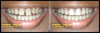Before and after pictures of using Lumineers® to close tooth gaps.