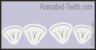Animation showing a situation where Lumineers® can be used to 'straighten' teeth but may not make the best choice.
