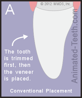 Diagram showing the difference between no-drilling and conventional veneer placement.