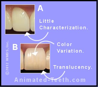 Picture showing a comparison of characterized vs. monochromatic porcelain veneers.