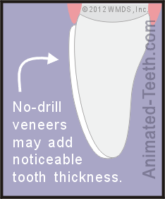 Diagram showing how the use of no-drill veneer placement may add noticeable thickness to a tooth.