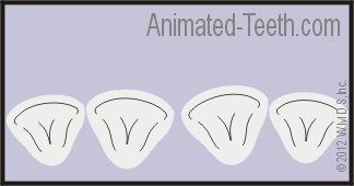 Animation showing how tooth preparation may be needed to properly 'straighten' teeth using veneers.