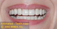 Picture of a makeover case after porcelain veneer placement.