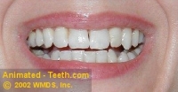 Picture of a makeover case before porcelain veneer placement.
