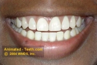 Picture of makeover case after porcelain veneer placement.
