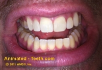 Picture of a makeover case after porcelain veneer placement.