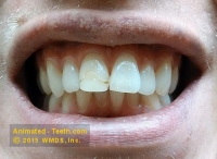 Picture of makeover case before porcelain veneer placement.