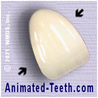 A picture of a veneer that has debonded from its tooth but remained intact.