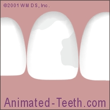 Animation showing the preparation of a tooth for a porcelain veneer.