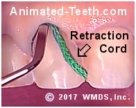 Picture of placing retraction cord around a tooth before its impression is taken.